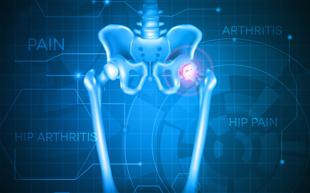 Understanding Arthritis of the Hip and How To Treat It Mahwah Valley