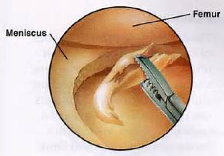 The Different Types of Meniscus Tears (And How They’re Treated) | Mahwah Valley Orthopedic ...