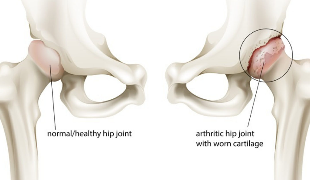 Can Corticosteroid Injections Be Used to Treat Hip
