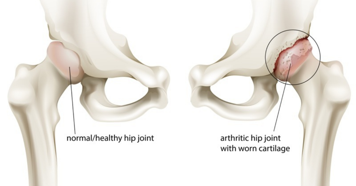 4 Hip Osteoarthritis Treatment Options | Mahwah Valley ...
Osteoarthritis Hip Pain