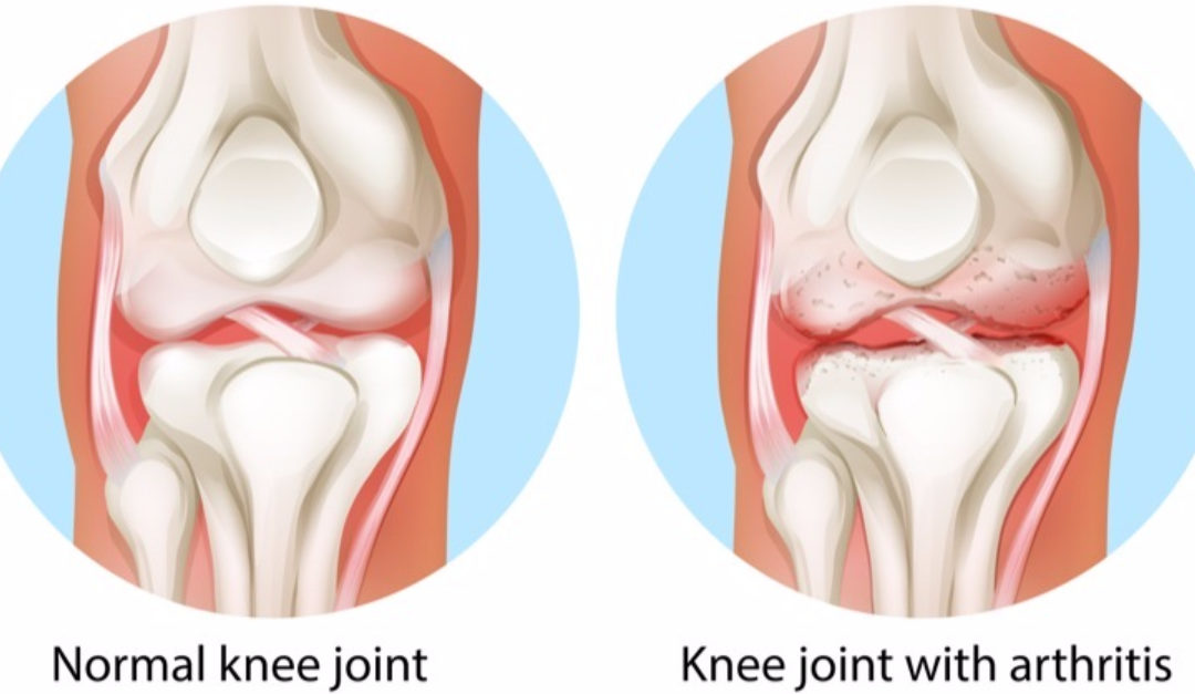 Nonsurgical Treatment of Osteoarthritis Related Knee Pain Mahwah